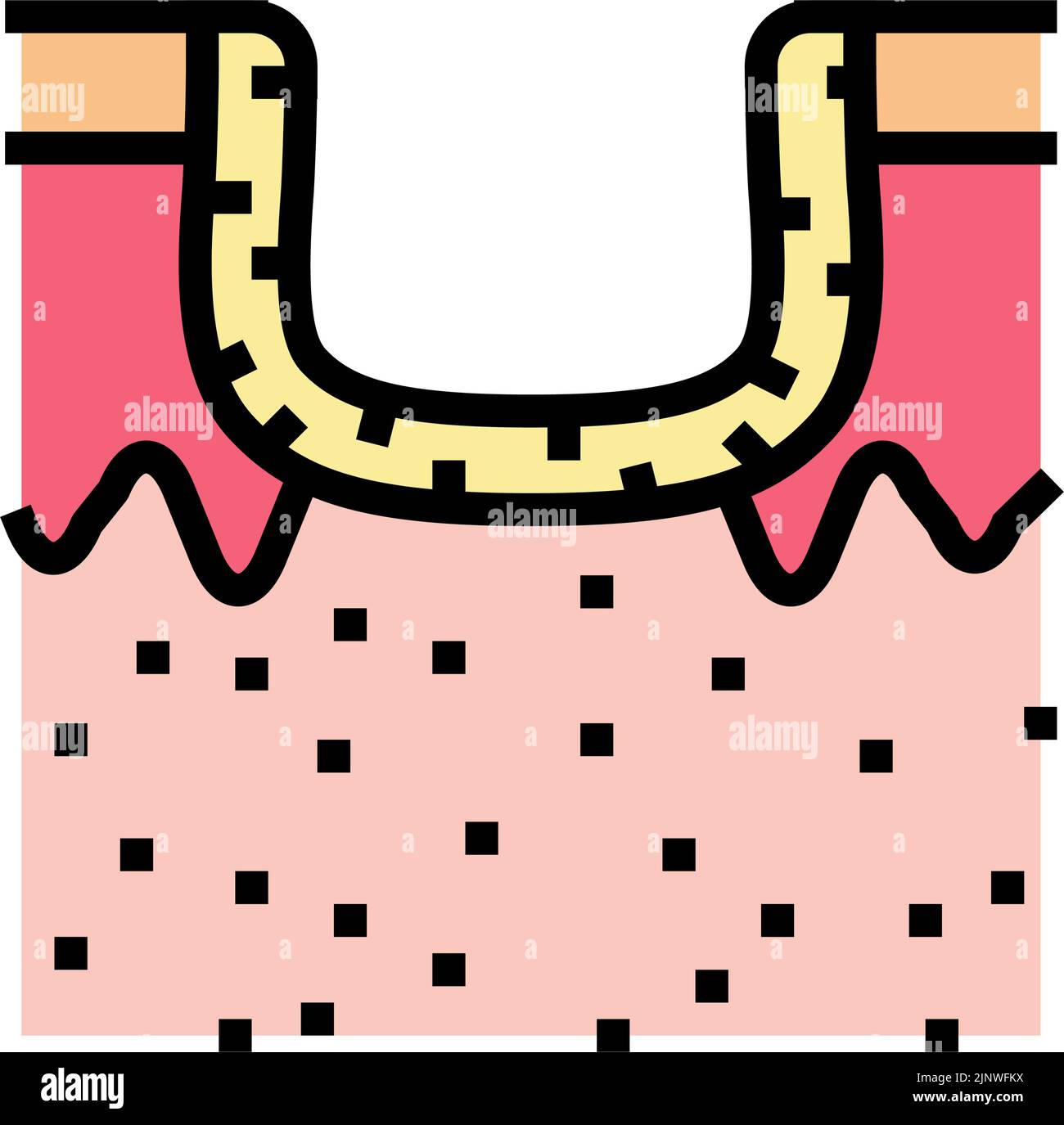 Hypertrophe Akne Narbe Farbe Symbol Vektor Illustration Stock Vektor