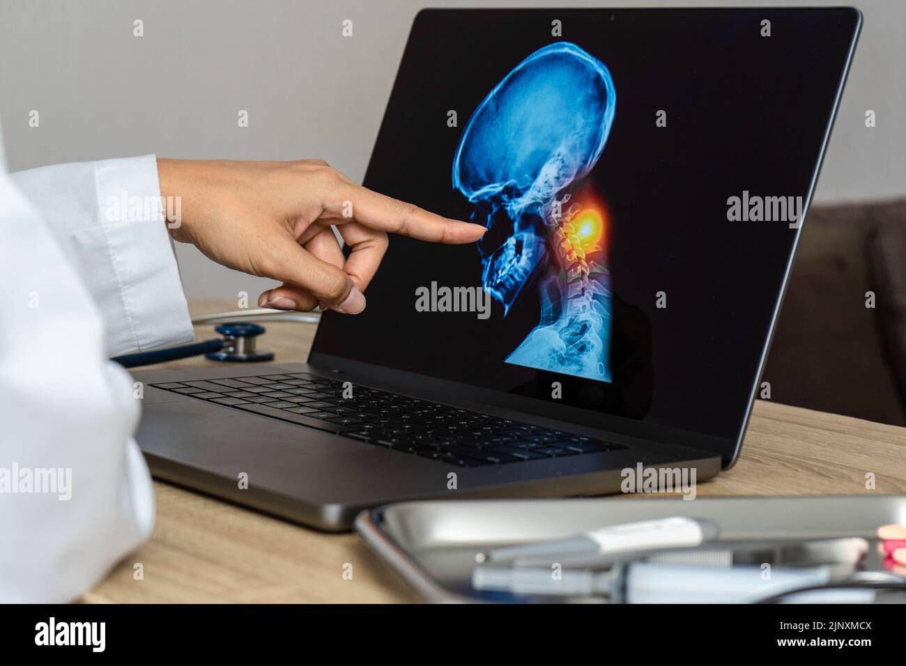 Arzt, der eine Röntgenaufnahme von Schmerzen im Nacken zeigt. Migräne und Rückenschmerzen. Stockfoto