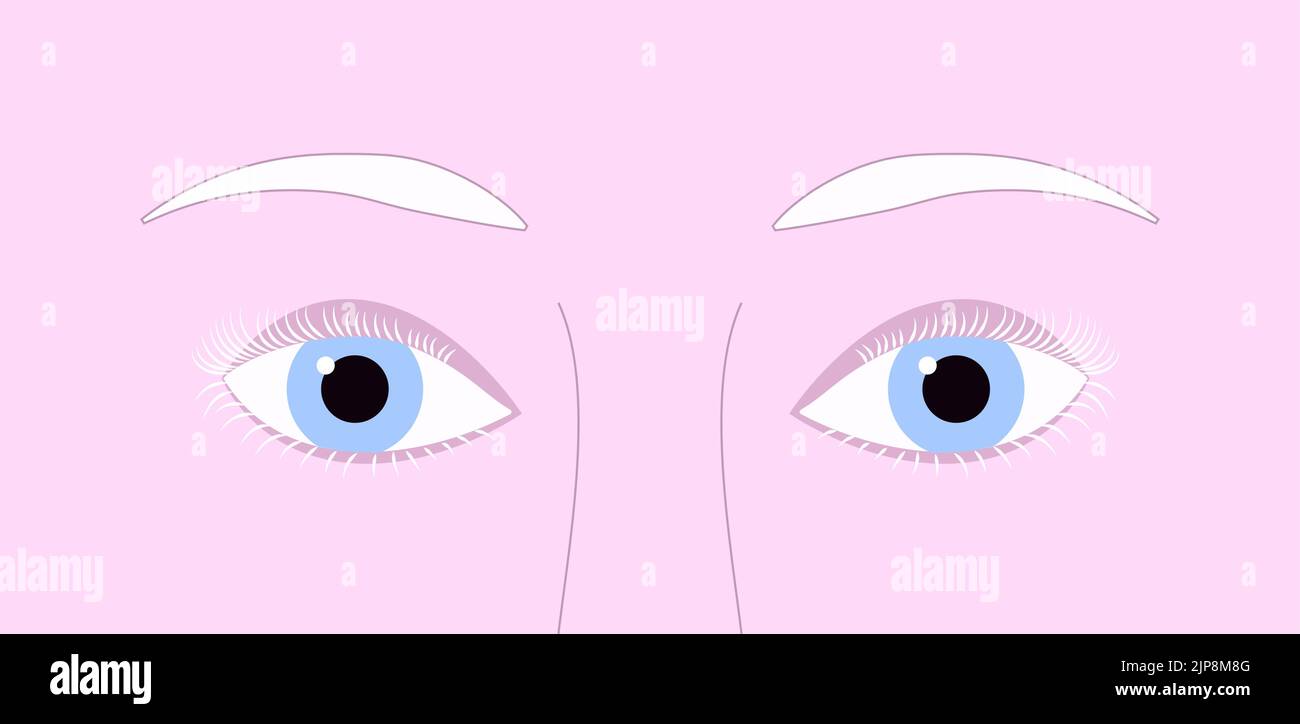 Nahaufnahme hellblaue Augen von Albino Person mit rosa Haut und weißen depigmentierten Wimpern und Augenbrauen Stock Vektor