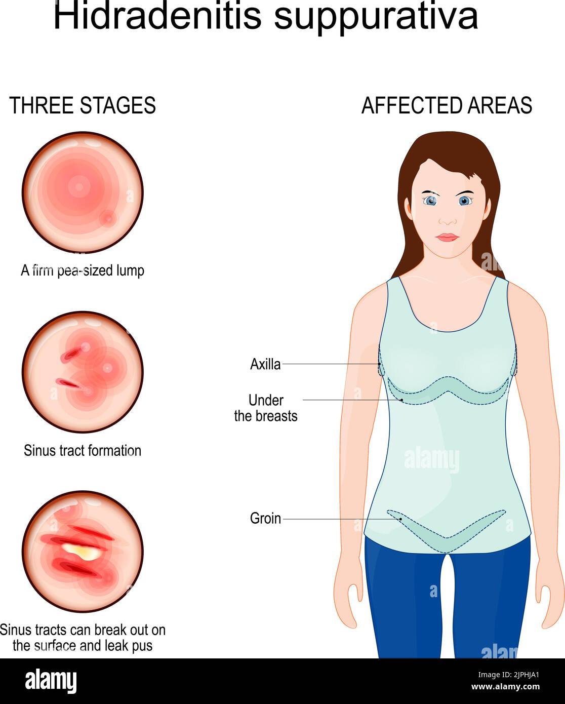 Hidradenitis suppurativa. Betroffene Bereiche der Akne inversa. Drei Stadien der Verneuil-Krankheit. Nahaufnahme der menschlichen Haut mit Bildung des Sinus-Traktes. Stock Vektor