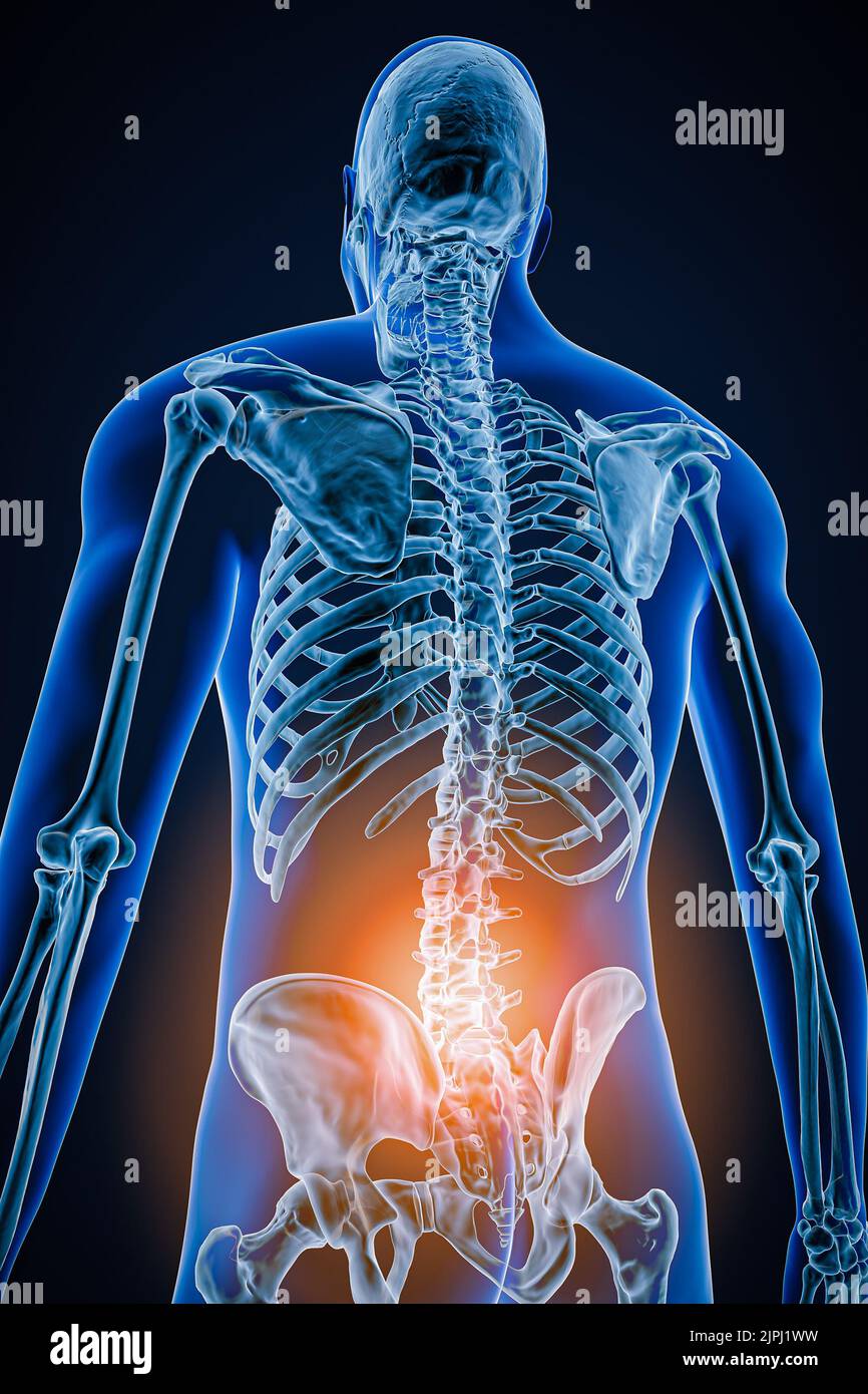 Hintere oder hintere Ansicht der menschlichen Wirbelsäule oder Wirbelsäule mit Entzündung oder Verletzung 3D Darstellung der Abbildung. Pathologie, Rückenschmerzen, Anatomie, lumba Stockfoto