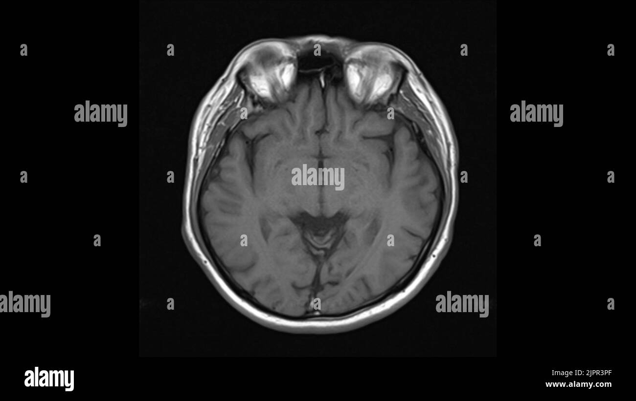 Gesundes Gehirn, MRI-Scan Stockfoto