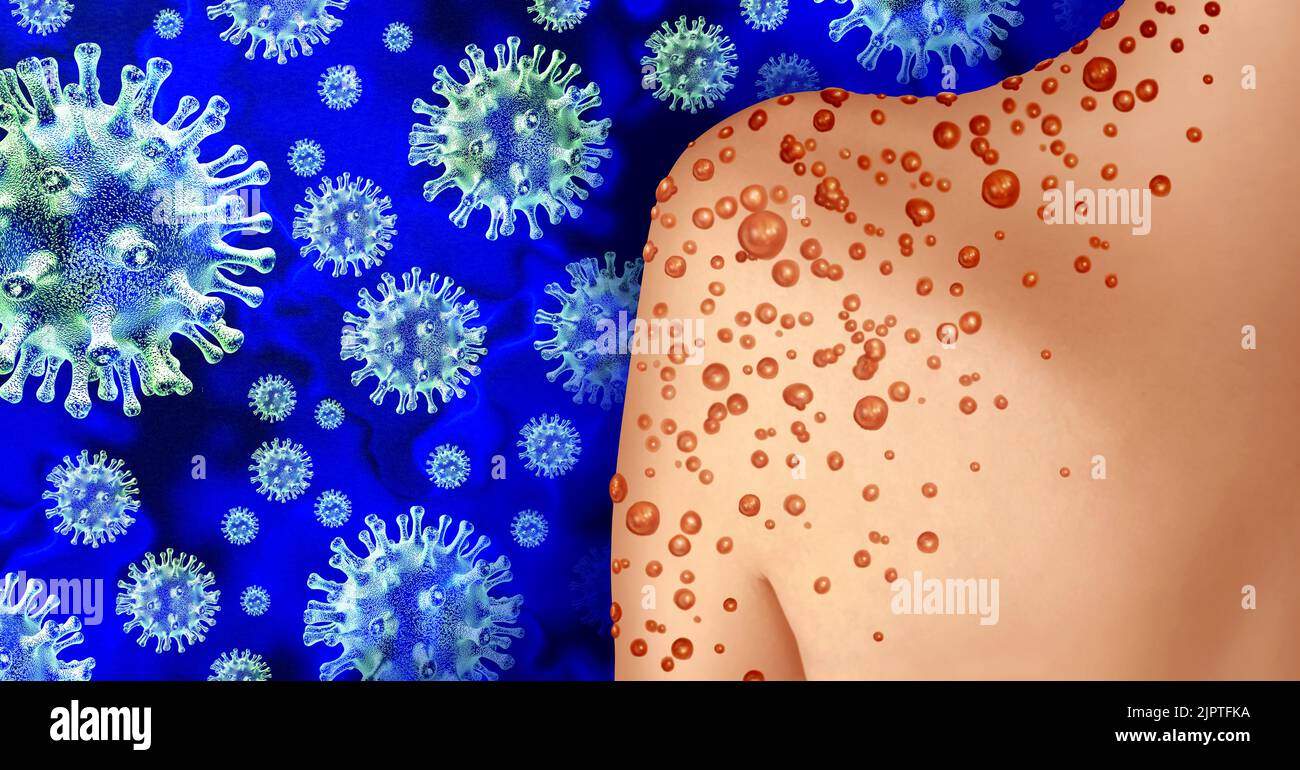 Affenpocken- oder Monkeypox-Virus-Ausbruch als ansteckende Infektion als Blasen und Gifte auf der Haut, die die Übertragung einer infizierten Person darstellen Stockfoto