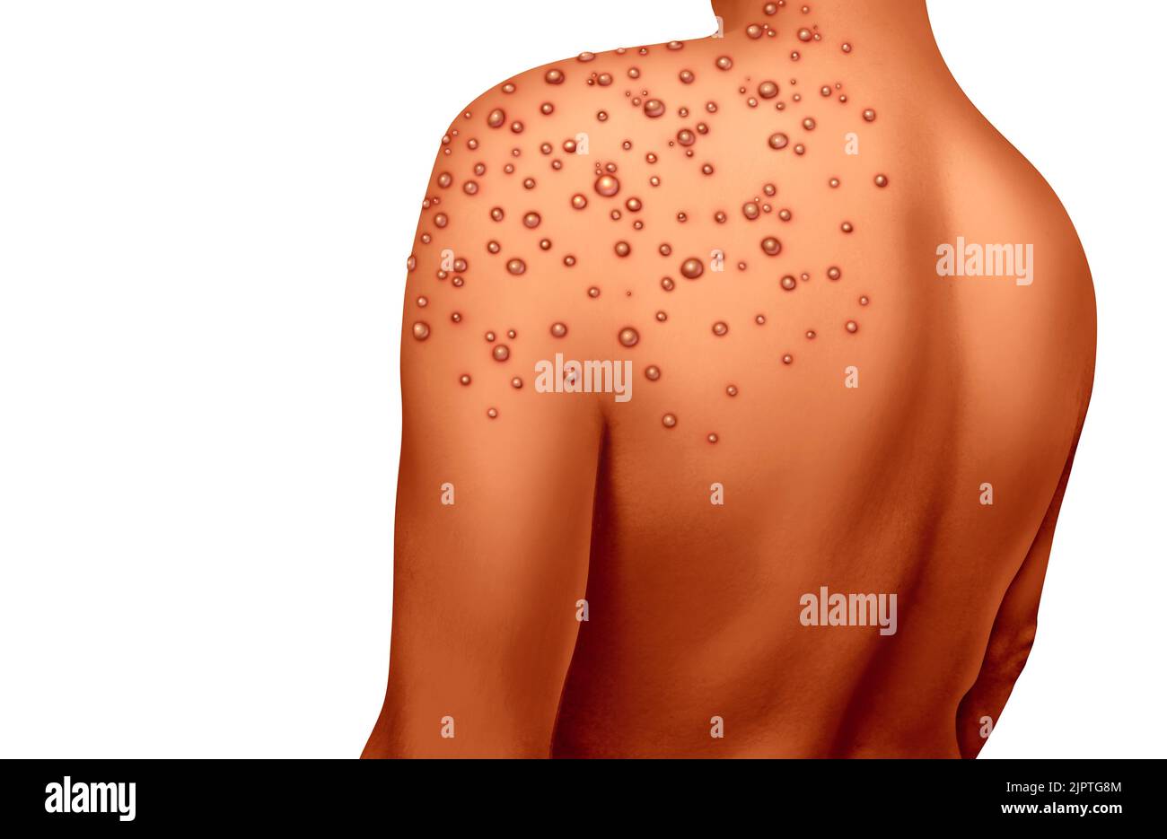 Monkeypox- oder Monkey Pox-Virus-Ausbruch als ansteckende Infektion als Blasen und Gifte auf der Haut, die die Übertragung einer infizierten Person darstellen. Stockfoto