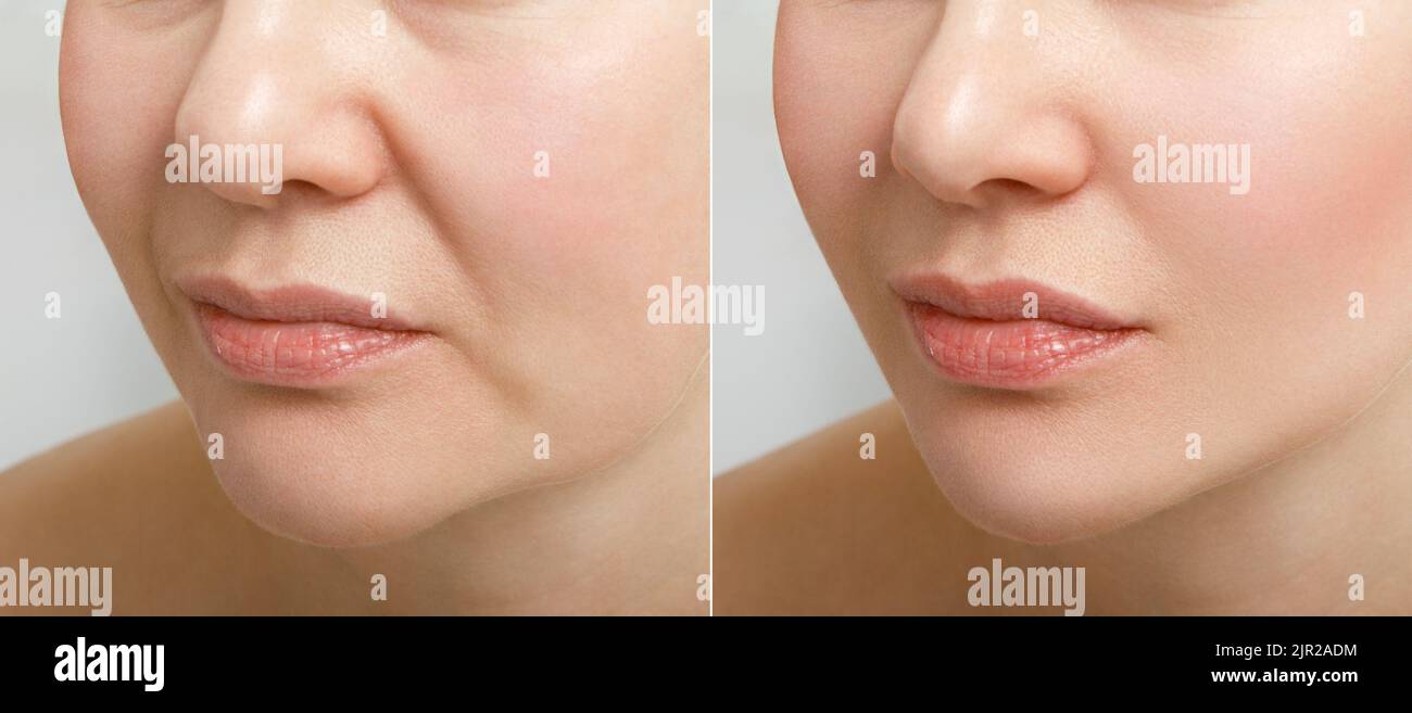 Porträt einer älteren Frau vor und nach dem Facelift. Das Ergebnis der Gesichtsverjüngung und Faltenglättung in einer Kosmetikklinik. Stockfoto