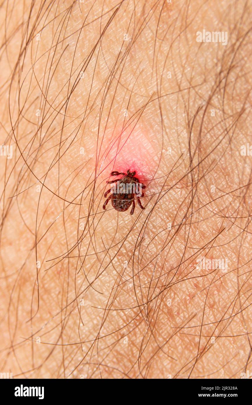 Kriechende Hirsche ticken auf dem Hintergrund der menschlichen haarigen  Haut. Infektion mit gefhrlichen Insekten mit Krankheiten. Das Konzept der  Infektion von Insekten Stockfotografie - Alamy