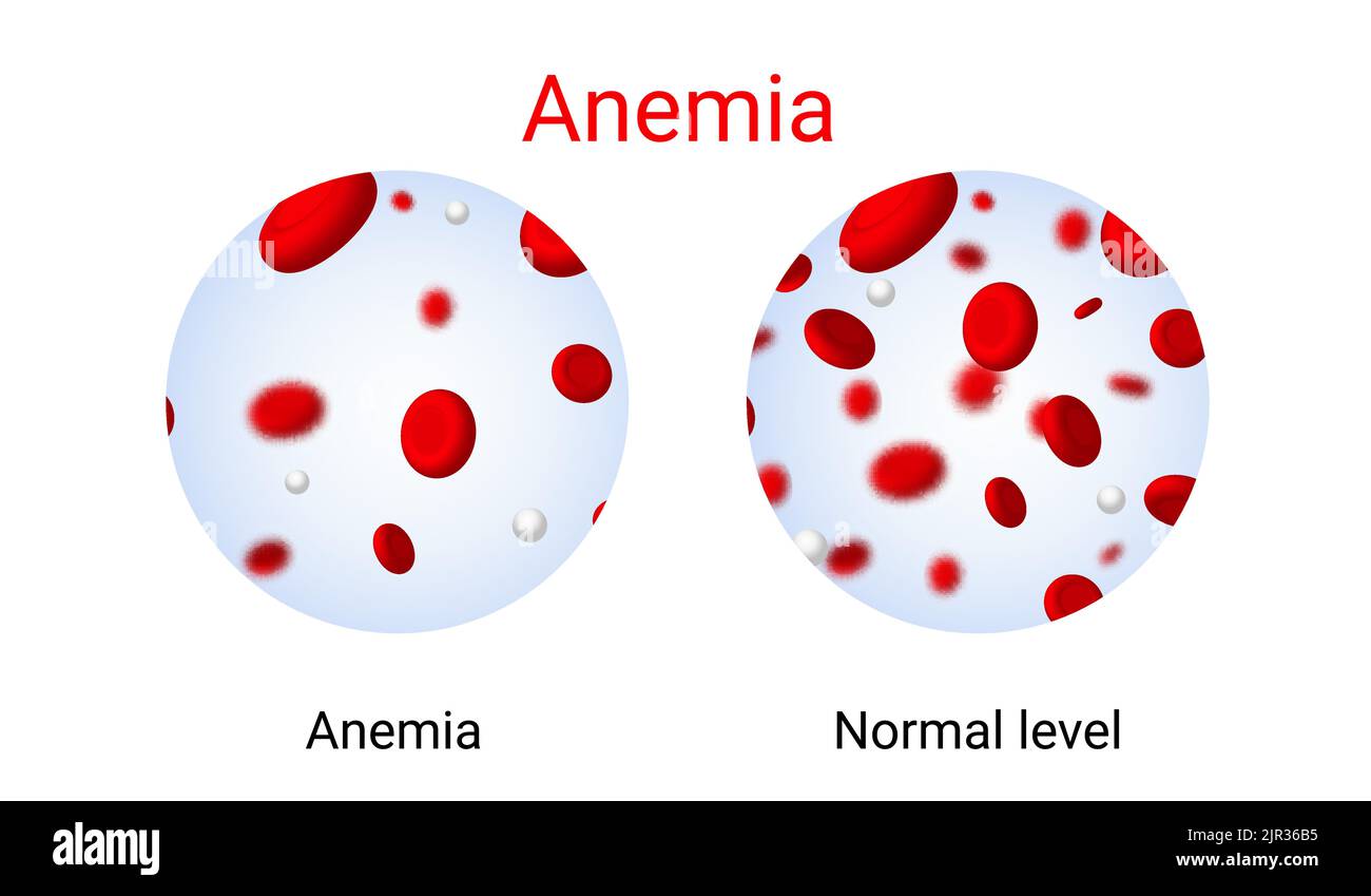 Anämie Problem Kreislauf Eisen Körper Diagramm Hintergrund. Anämiebiologie Blut isoliert medizinisch normal Symbol. Stock Vektor