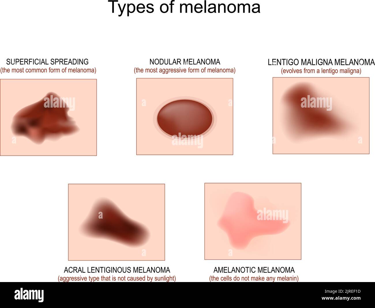 Arten von Hautkrebs. Oberflächliches sich ausbreitendes Melanom, Lentigo maligna und noduläres Melanom, Amelanotic-Krebs und Acral-lintiginöses Melanom. Vektor Stock Vektor