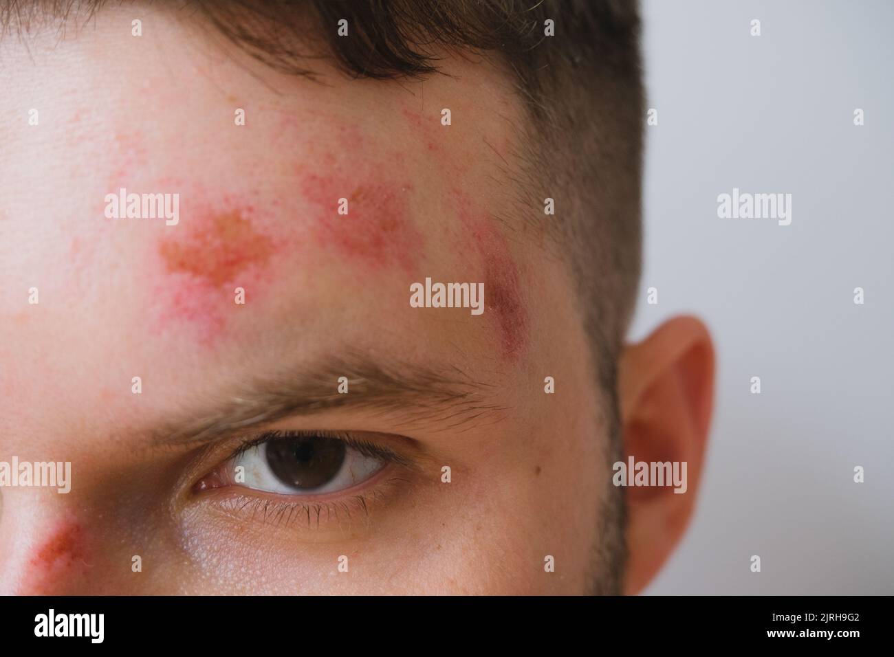 Nahaufnahme der brutal verletzten Männer Gesicht Porträt, Verletzungen Kratzer nach Unfall, Infektion medizinischen Schutz Stockfoto