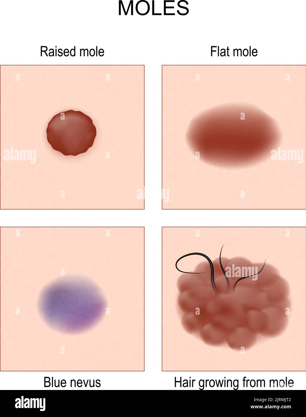 Nevus- oder Maulwurftypen. Nevus prüfen. Blauer Nevus, flacher oder erhöhter Maulwurf. Haare wachsen aus Maulwurf. Poster für Onkologie, Dermatologie und medizinische Verwendung. Vektor Stock Vektor