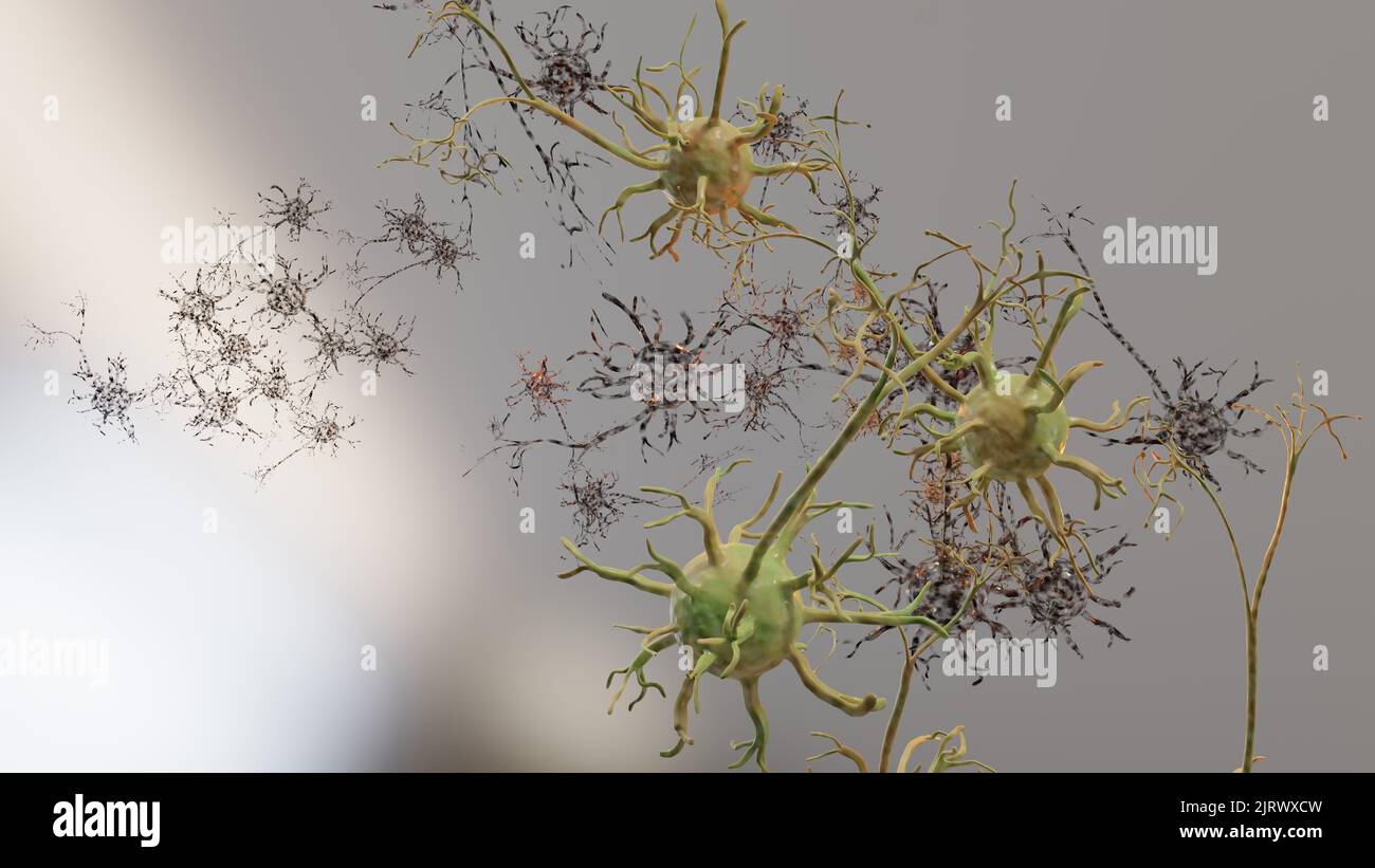 Leichte traumatische Hirnverletzung, geschädigte Neuronen, alzheimer-Krankheit, diffuse axonale Verletzung, Störung der Nervenkommunikation, 3D Render Stockfoto