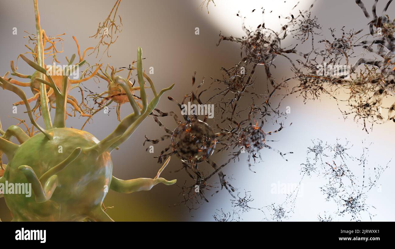 Leichte traumatische Hirnverletzung, geschädigte Neuronen, alzheimer-Krankheit, diffuse axonale Verletzung, Störung der Nervenkommunikation, 3D Render Stockfoto