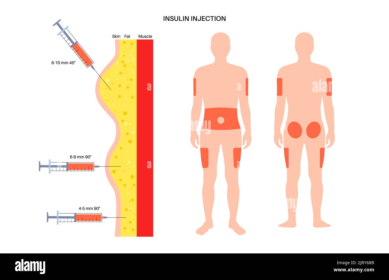 Insulin-Injektionsstellen, Abbildung Stockfoto