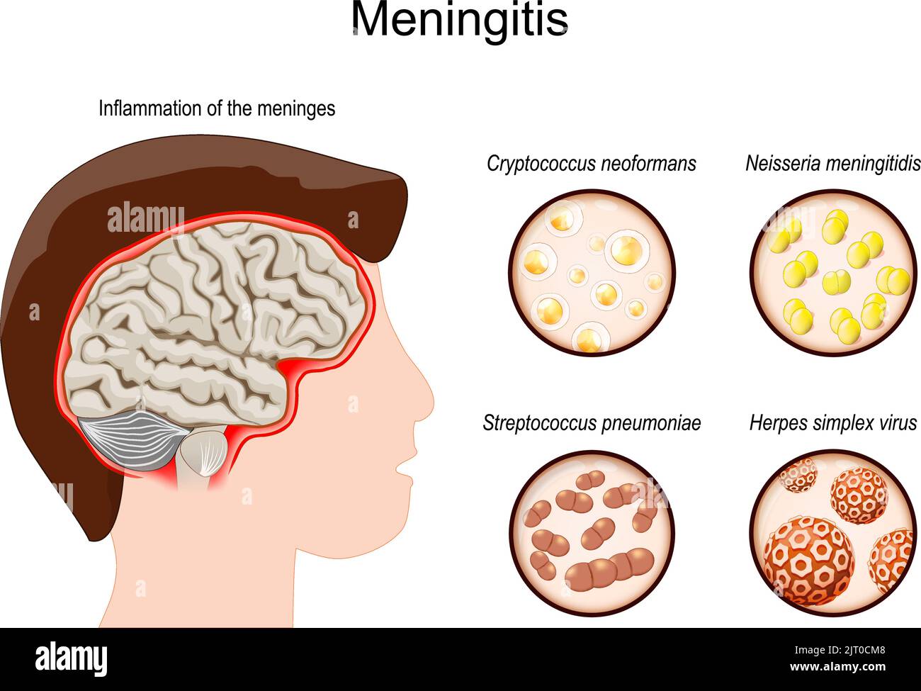 Meningitis. Gehirn des Menschen mit Entzündung der Hirnhäute. Krankheitserreger, die diese Krankheit verursacht haben. Die Entzündung, die durch Viren, Bakterien, Pilze verursacht wird Stock Vektor
