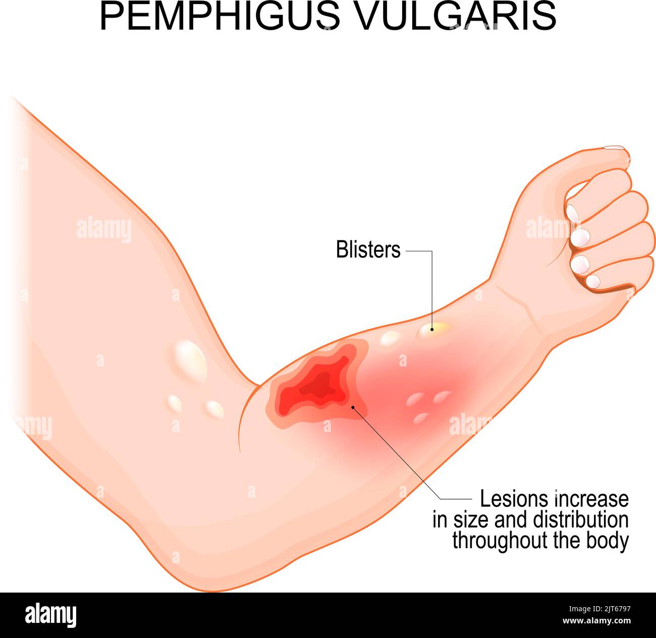 Pemphigus vulgaris. Arm mit Blasen und Läsionen, die in Größe und Verteilung im ganzen Körper zu erhöhen. Symptome einer Autoimmunerkrankung. Haut Stock Vektor