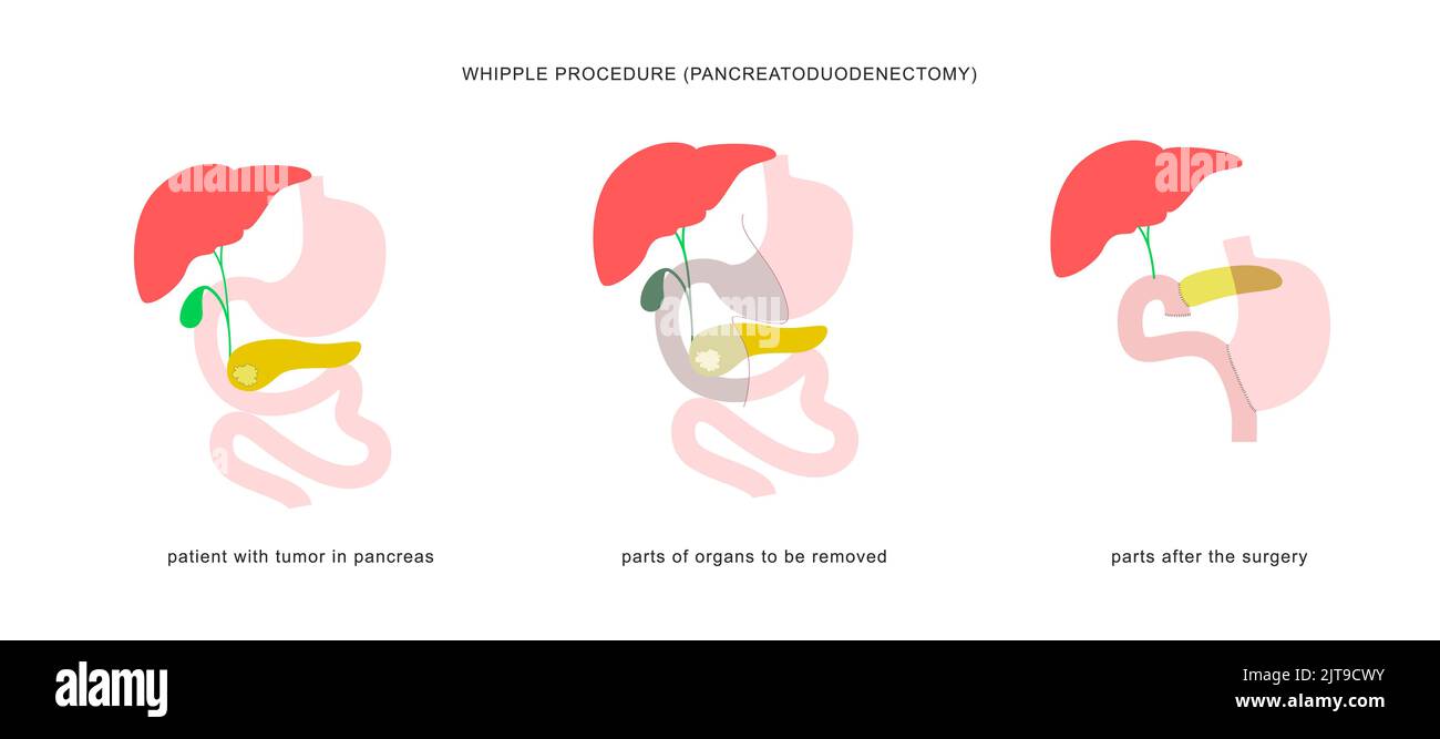 Medizinische Infografik des whipple-Verfahrens Pankreaticoduodenektomie mit Gastrojejunostomie. Operation Operation bei der Behandlung von Bauchspeicheldrüsenkrebs. Stock Vektor