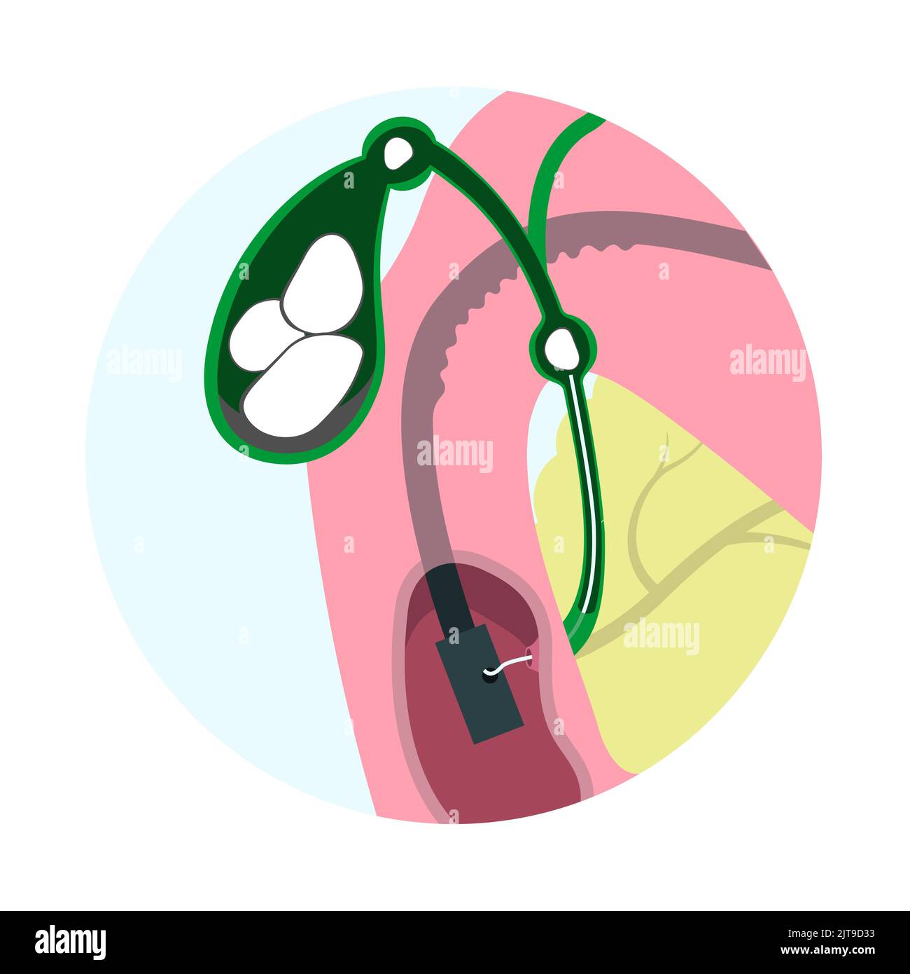 Endoskopische Entfernung von Gallenblasenstein durch Mund, Magen, Gallengang. Closup medizinische Operation Infografiken. Stock Vektor