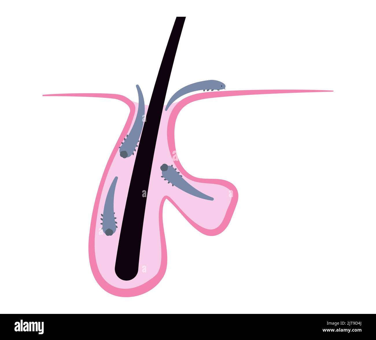Haarfollikel voller Demodex-Milben, einfache Flat Chart. Medizinische Illustration Stock Vektor