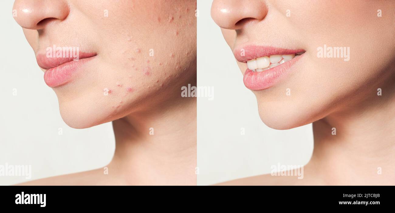Teenager-Mädchen vor und nach Akne-Behandlung Hautpflege Konzept. Akne-Behandlung in einer Kosmetologie-Klinik. Stockfoto