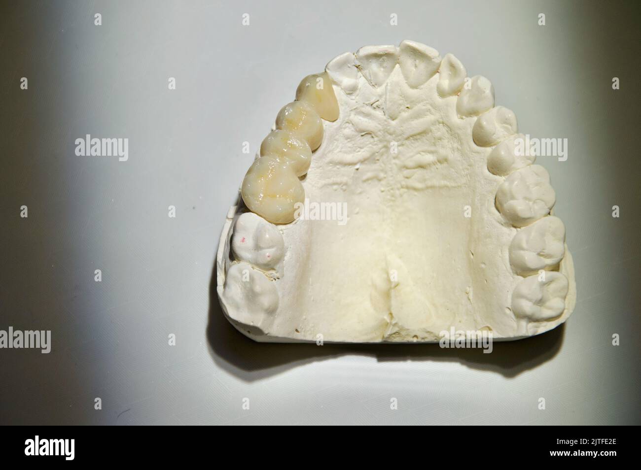 Zahnbrücke auf Putz Zahnbogen, Zahnheilkunde Prothese Zähne Implantat ...
