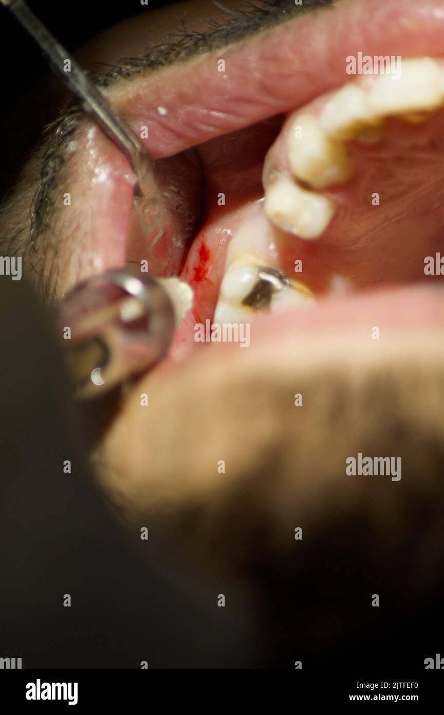 Infiltration Zahnanästhesie auf Zahnarzt-Patienten, prothetische zahnärztliche Vorbereitung durch Zahnarzthelfer bei der Arbeit Stockfoto