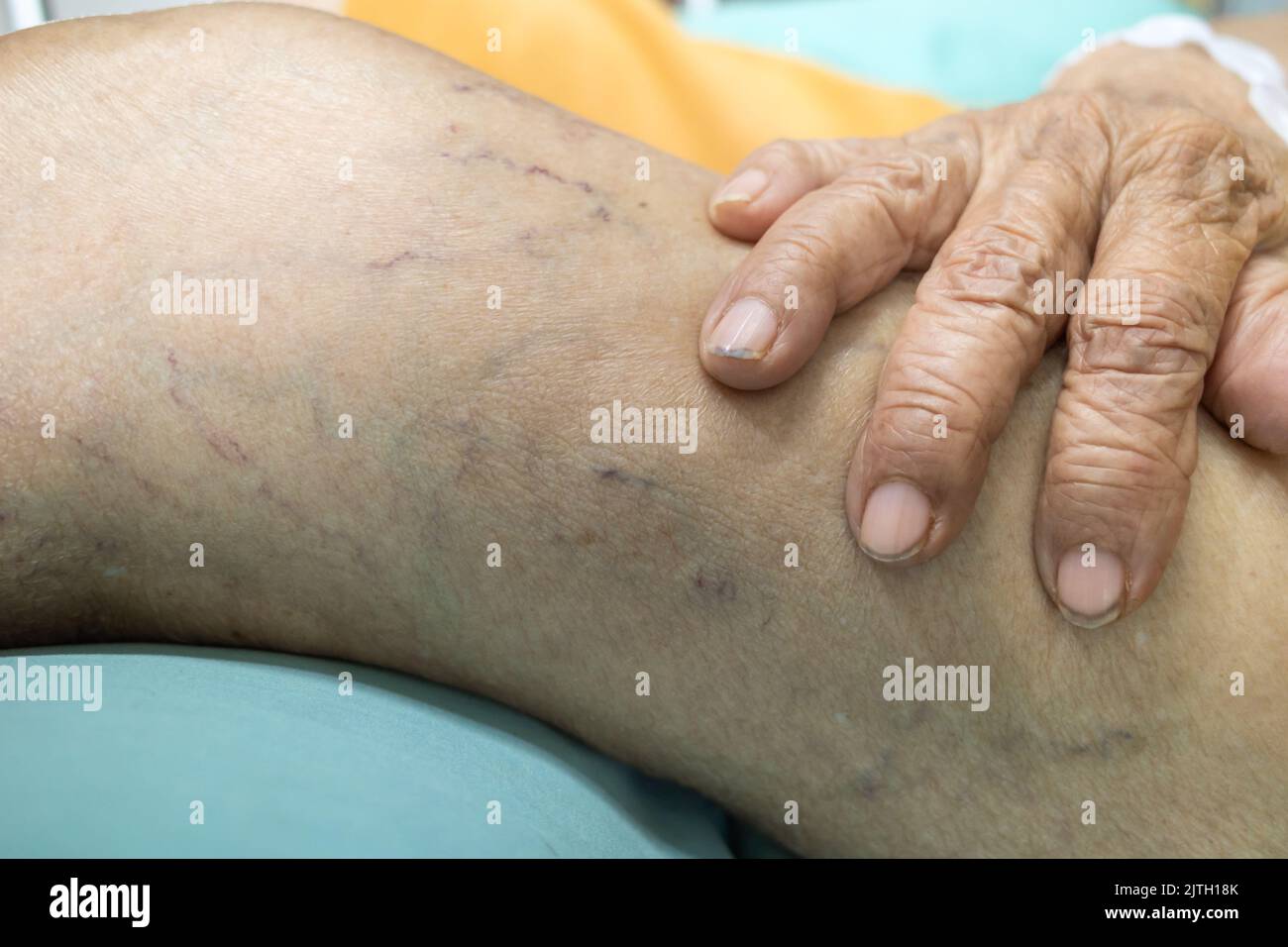 Hand eines älteren Patienten mit Krampfadern am Oberschenkel Stockfoto