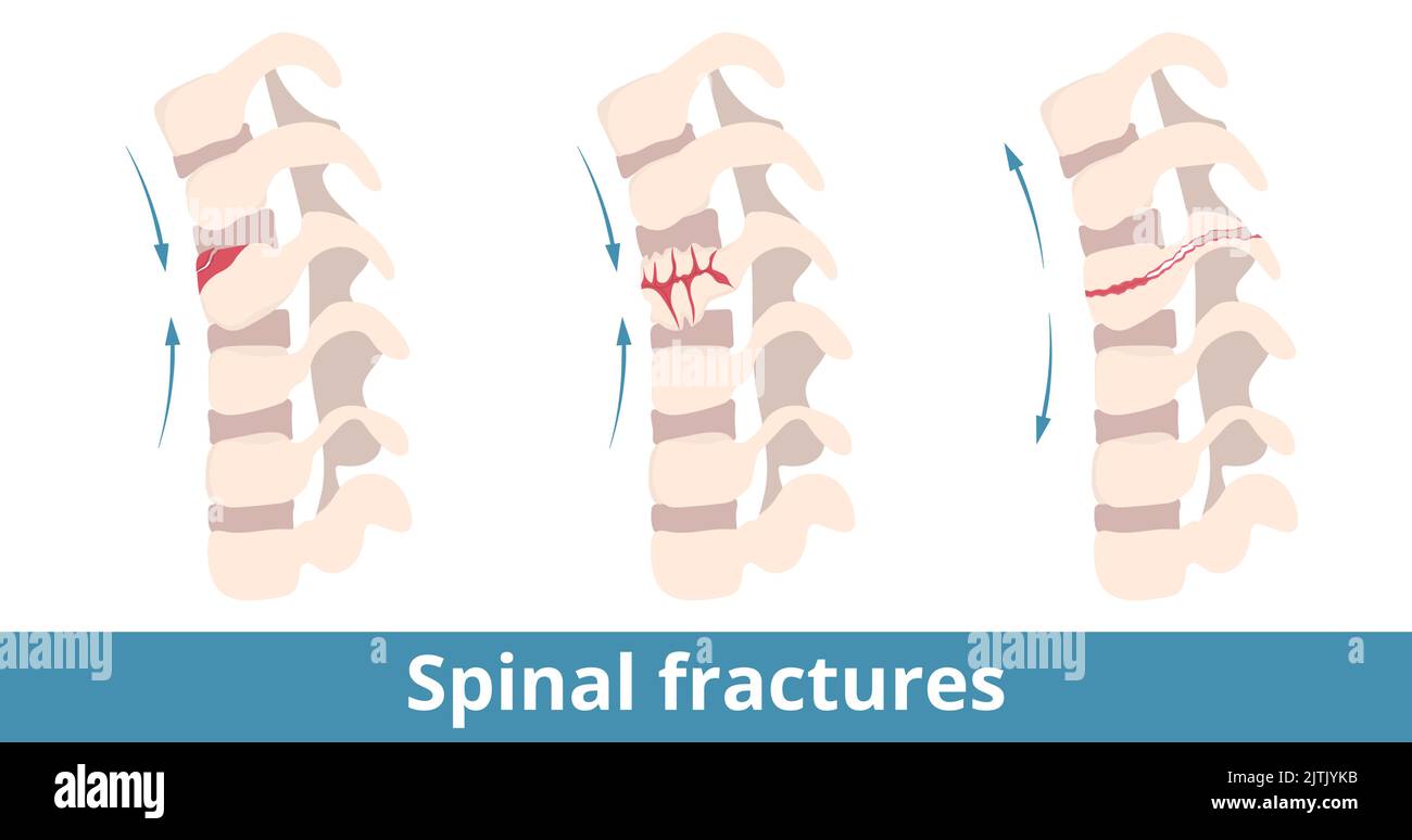 Wirbelsäulenfrakturen. Arten von Wirbelsäulenfrakturen hängen von der Schadensrichtung ab. Bruch der Wirbel (Rückgrat) durch Verletzung, Trauma, Sturz, Sport Stock Vektor
