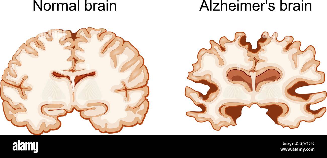 Normales Gehirn und Alzheimer-Gehirn. Neurodegenerative Erkrankung. Vektorgrafik Stock Vektor