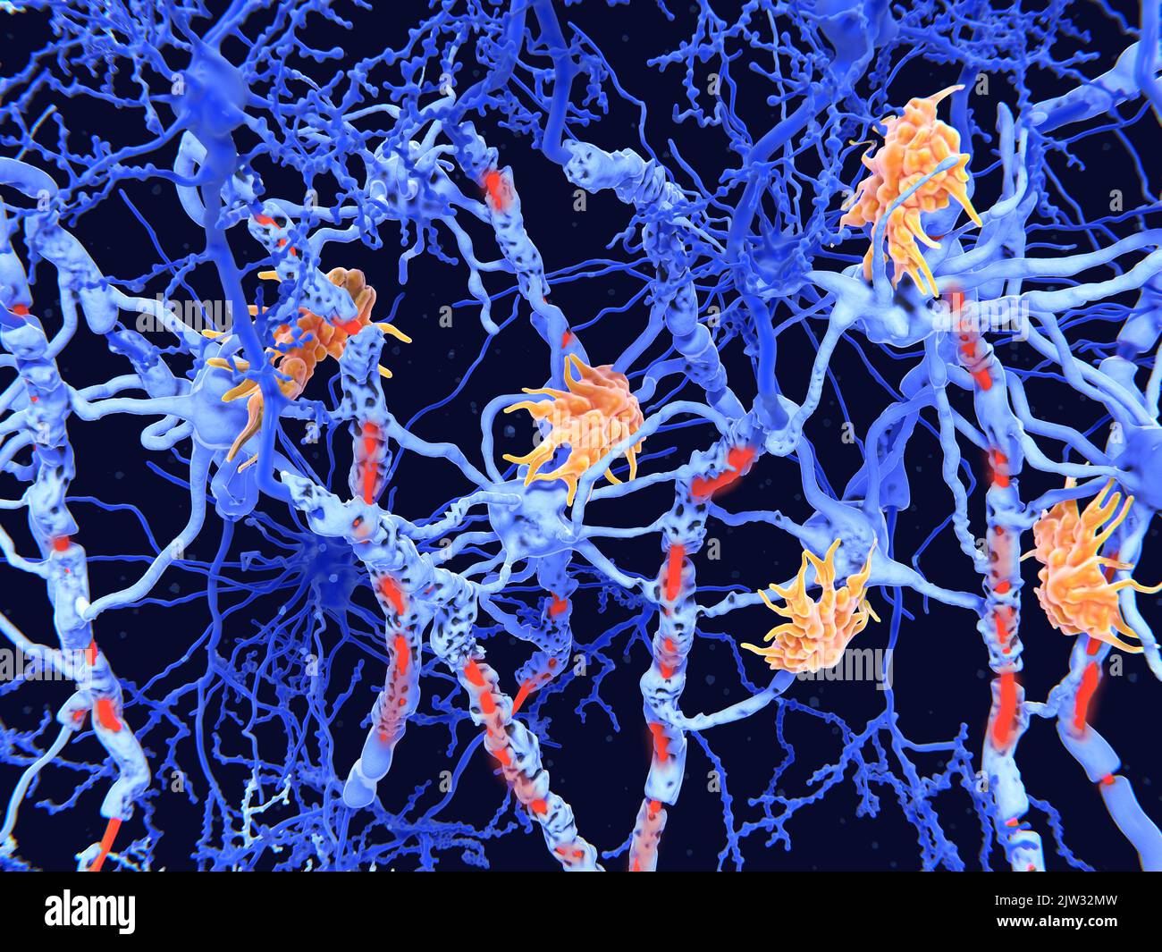 Illustration von beschädigten Nervenzellen, die durch die degenerative Erkrankung Multiple Sklerose verursacht werden. Zellen des Immunsystems (Mikroglia, Orange) haben die Nervenzellhüllen (Myelin) angegriffen, was zu einer geschädigten Myelin (rot) und gestörter Signalfunktion zwischen den Nervenzellen (Neuronen, blau) führte. Multiple Sklerose ist eine fortschreitende Erkrankung, die Kribbeln, Sprachstörungen, Koordinationsstörungen, Lähmungen und Tod verursachen kann. Die Mikroglia-Zellen greifen die Oligodendrozyten an, die die isolierende Myelinhülle um Neuronaxonen bilden, was zur Zerstörung der Myelinhülle führt. Stockfoto
