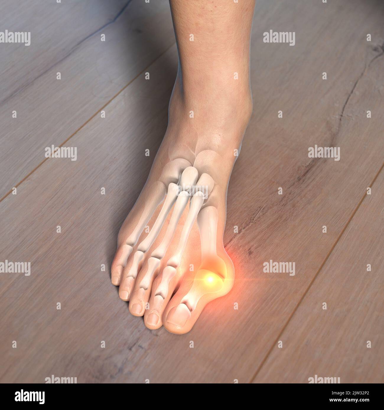 Hallux valgus, Illustration. Ein Hallux valgus, oder Bunion, ist eine abnorme Abweichung der Großzehe, die zu einer Deformation an der Vorderseite des Fußes am ersten Mittelfußbereich der Großzehe führt. Stockfoto