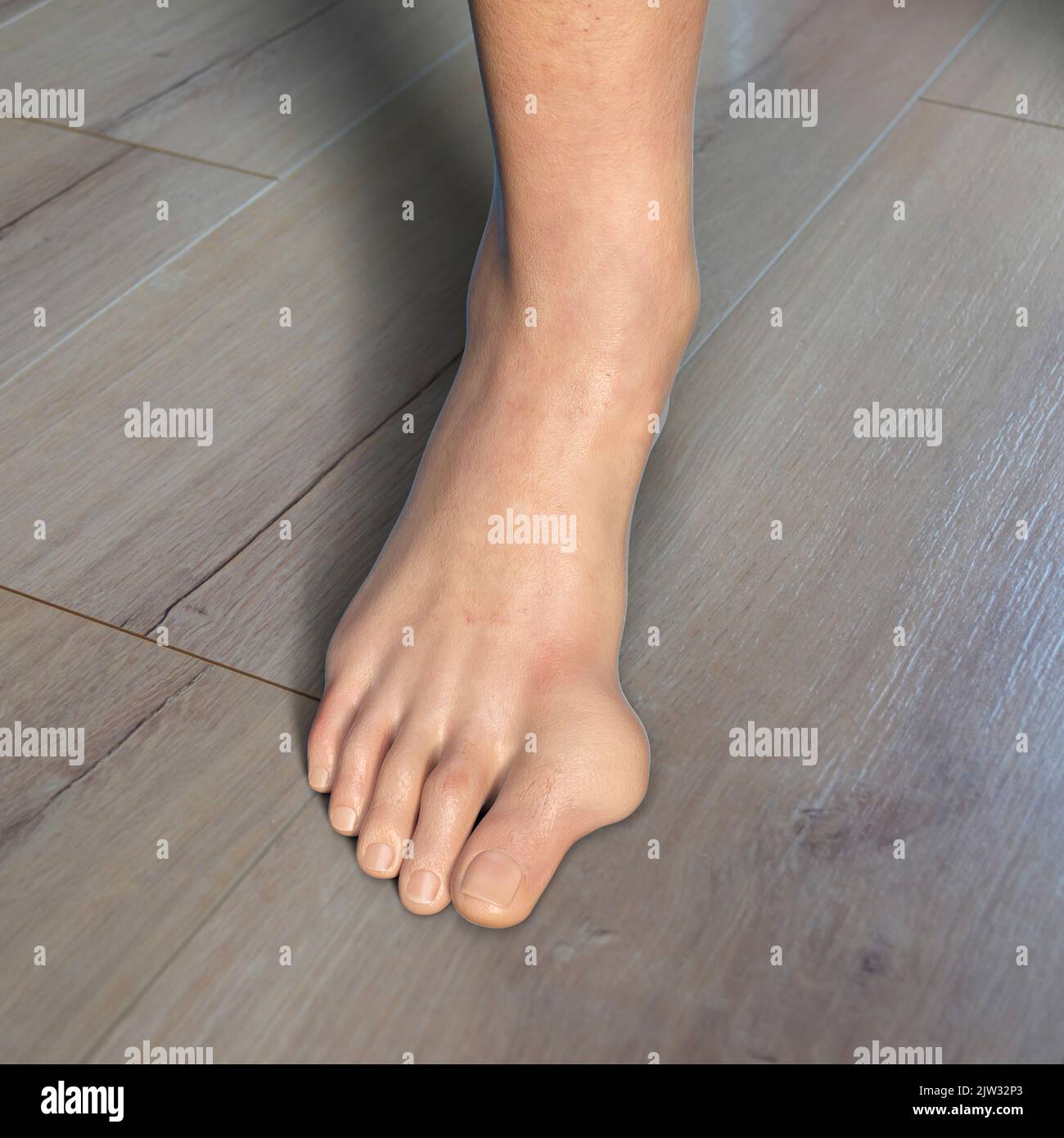 Hallux valgus, Illustration. Ein Hallux valgus, oder Bunion, ist eine abnorme Abweichung der Großzehe, die zu einer Deformation an der Vorderseite des Fußes am ersten Mittelfußbereich der Großzehe führt. Stockfoto