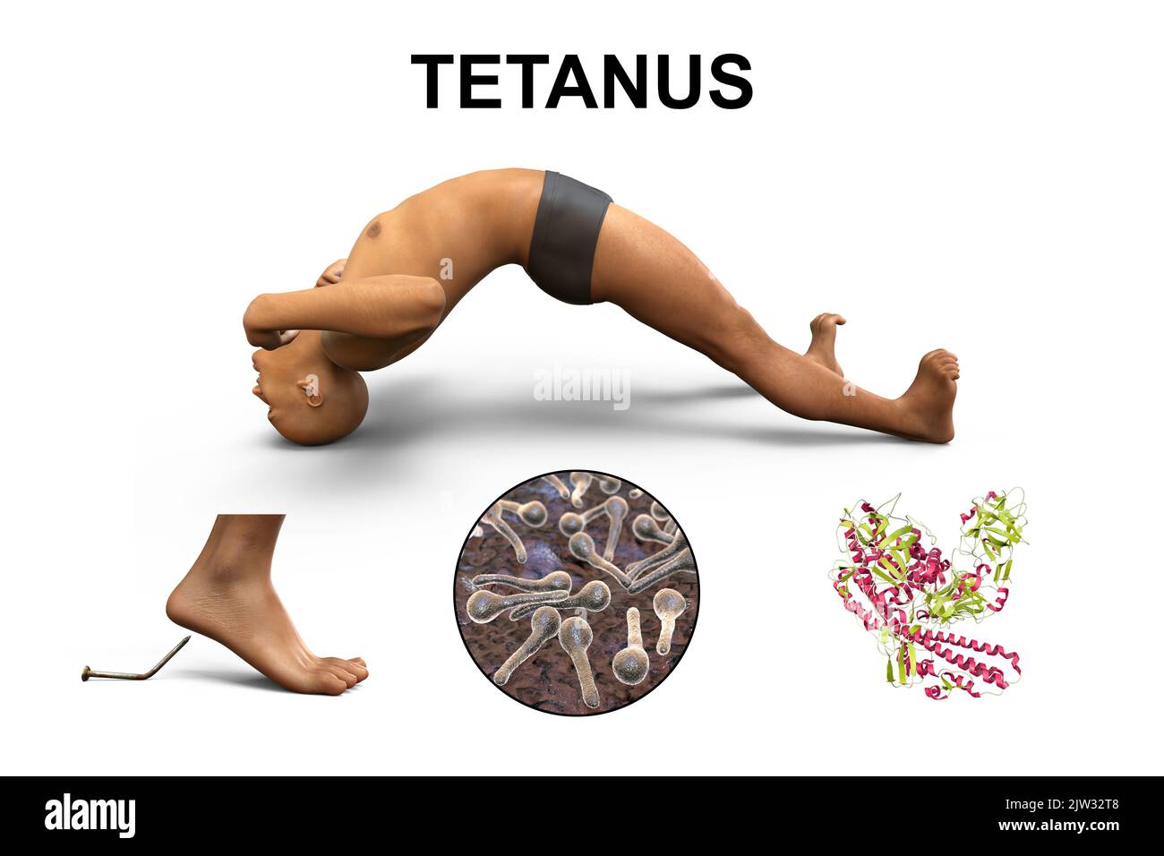 Mechanismus der Tetanus-Krankheit, Illustration. Eine Hautwunde ist mit Clostridium tetani-Bakterien kontaminiert, die ein Neurotoxin produzieren, das das Rückenmark erreicht und spastische Lähmungen verursacht. Der Mann befindet sich im Opisthotonus (Rückwärtsspasmus), einem Zustand schwerer Hyperdehnung und Spastik. Stockfoto