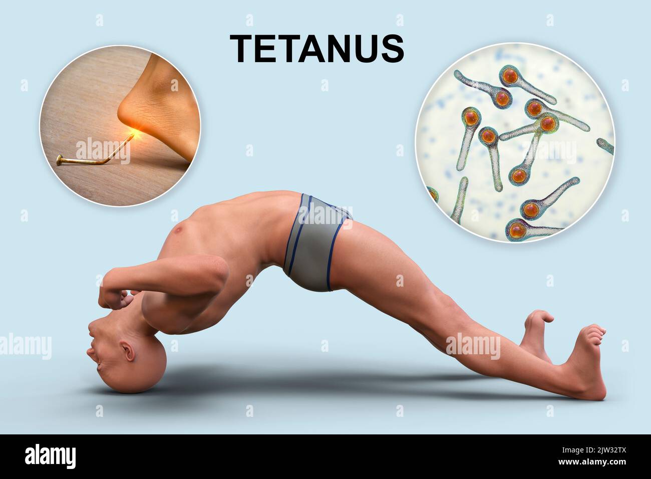 Mechanismus der Tetanus-Krankheit, Illustration. Eine Hautwunde ist mit Clostridium tetani-Bakterien kontaminiert, die ein Neurotoxin produzieren, das das Rückenmark erreicht und spastische Lähmungen verursacht. Der Mann befindet sich im Opisthotonus (Rückwärtsspasmus), einem Zustand schwerer Hyperdehnung und Spastik. Stockfoto