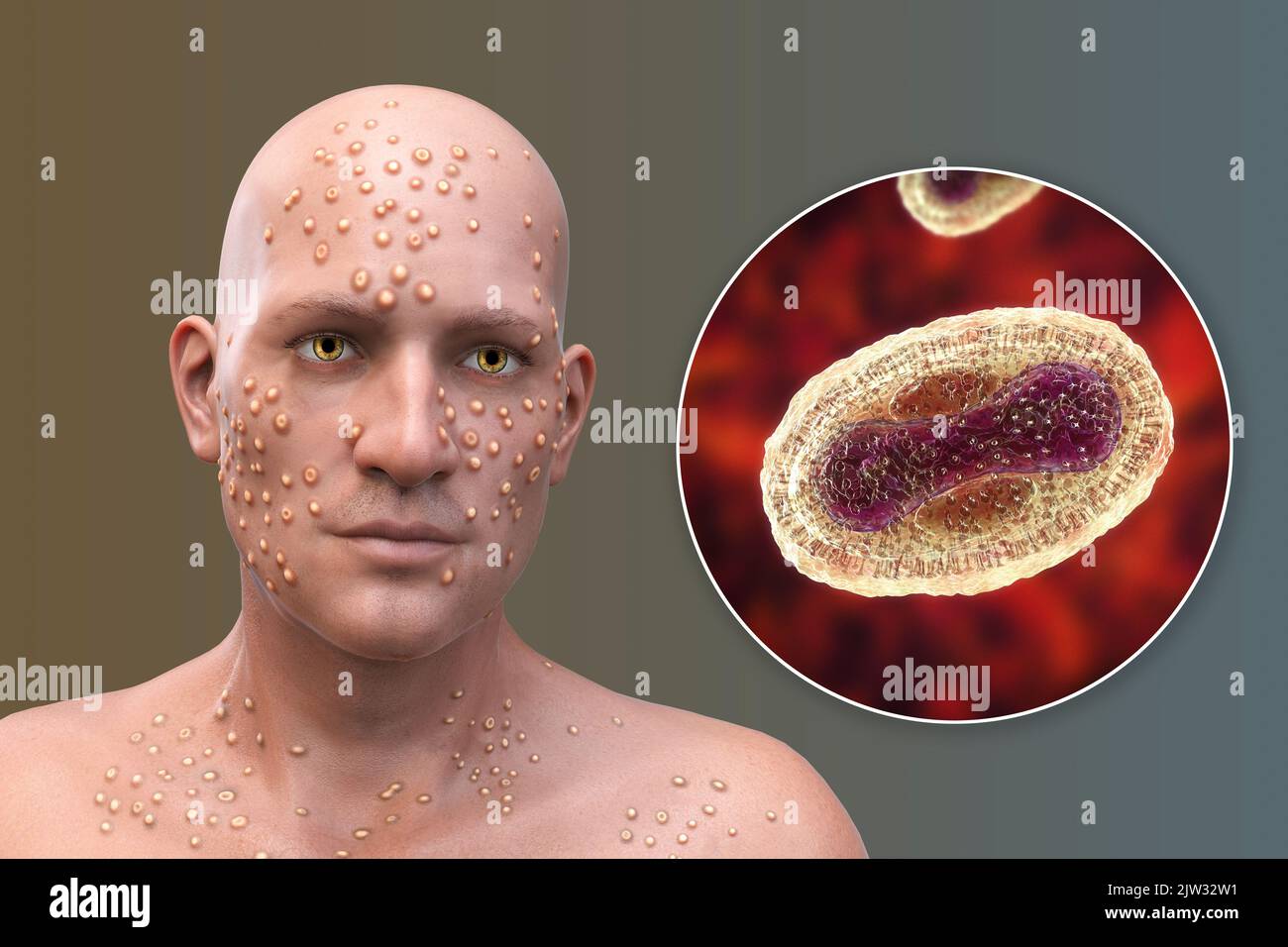 Patient mit Pocken (Variola) und Nahaufnahme eines Pockenvirus, Illustration. Pocken sind eine Krankheit, die Fieber und oft den Tod verursacht. Es wurde nach weltweiten Anstrengungen im Jahr 1970s ausgerottet, aber es gibt Stämme in Forschungslabors. Ähnliche Hautläsionen finden sich in derzeit verfügbaren Viren aus der Poxviridae-Familie, wie z. B. Monkeypox, die ebenfalls die gleiche Virion-Morphologie haben. Stockfoto