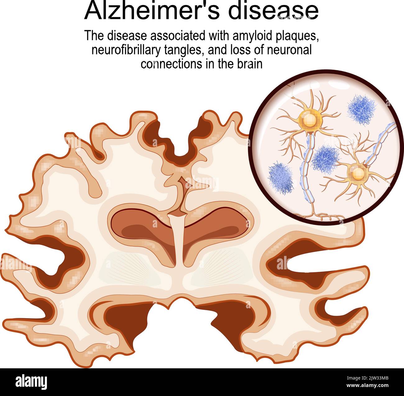 Alzheimer-Krankheit. Krankheit im Zusammenhang mit Amyloid-Plaques, neurofibrillaren Verwicklungen und Verlust neuronaler Verbindungen im Gehirn. Menschliches Gehirn Stock Vektor