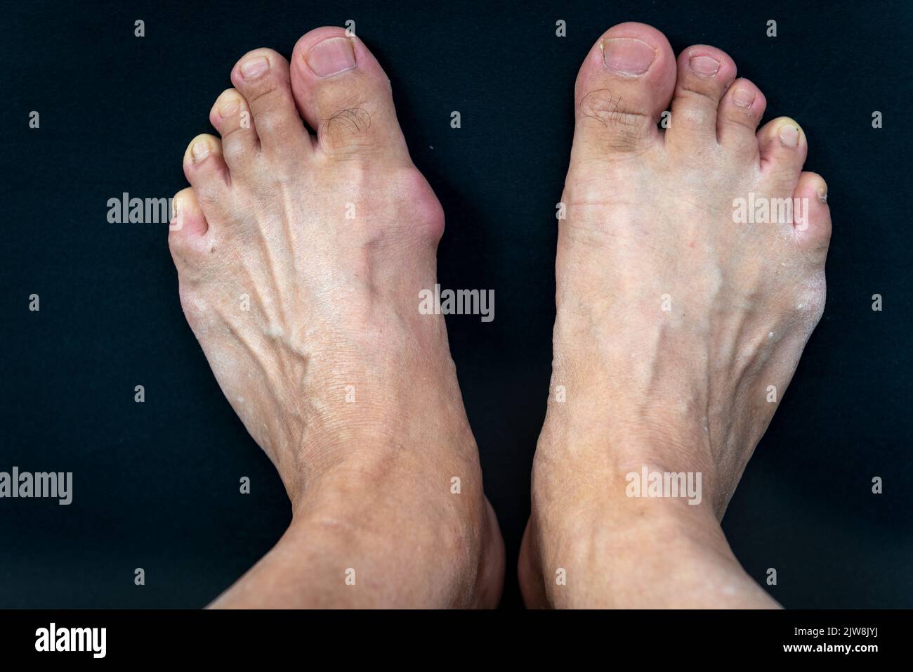 Ein Fuß mit einer Gicht-Bunion im Vergleich zu einem normalen in schwarzem Hintergrund isoliert. Stockfoto