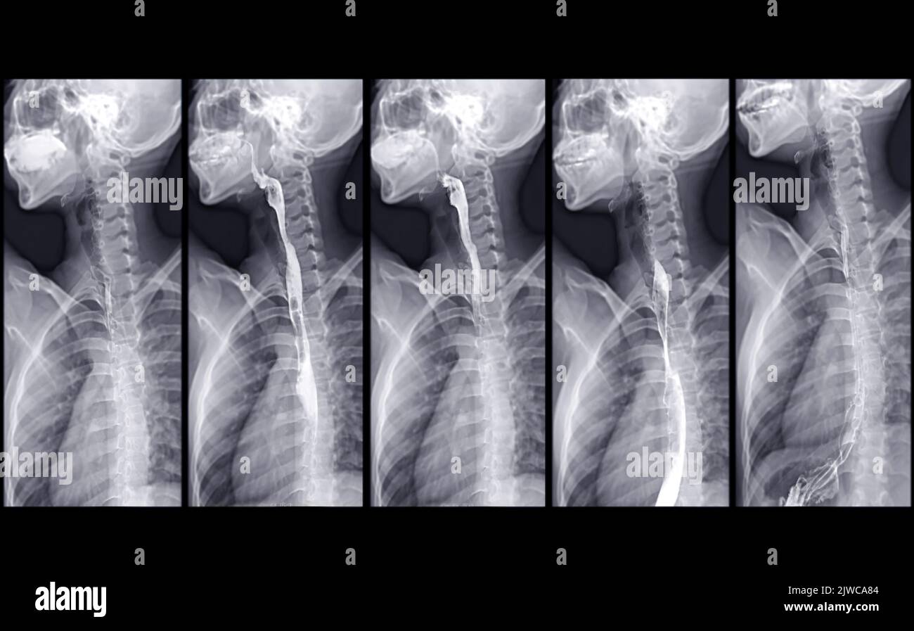 Barium Swallow study Test diagnostiziere Barrett's GI tract exam GERD ulcers series difficulty pharynx procedure UGI throat darm therapy by Fluoroscopy dev Stockfoto