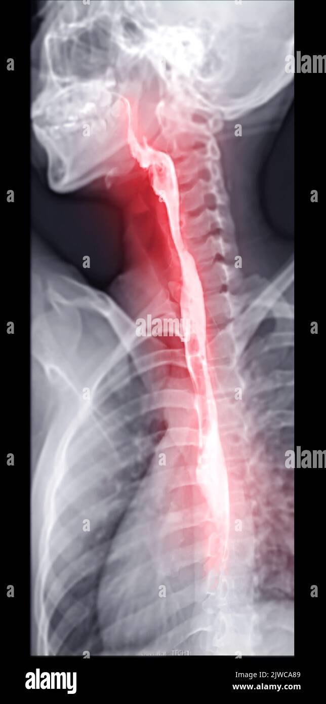 Barium Swallow study Test diagnostiziere Barrett's GI tract exam GERD ulcers series difficulty pharynx procedure UGI throat darm therapy by Fluoroscopy dev Stockfoto