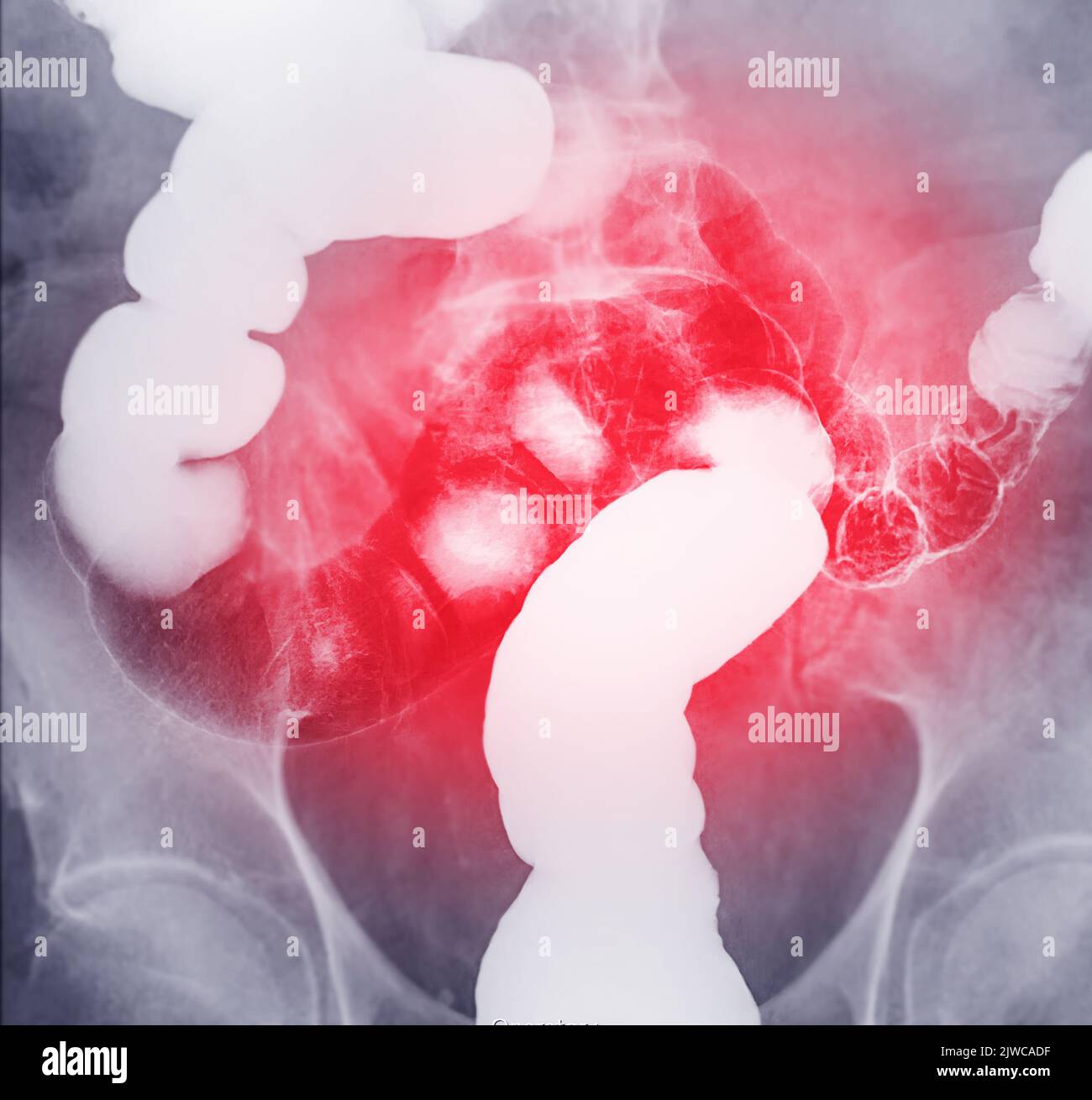 Barium Enema oder BE ist ein Bild des Dickdarms nach Injektion von Bariumkontrast füllen in den Dickdarm unter fluoroskopischer Kontrolle isoliert auf weißem Hintergrund Stockfoto