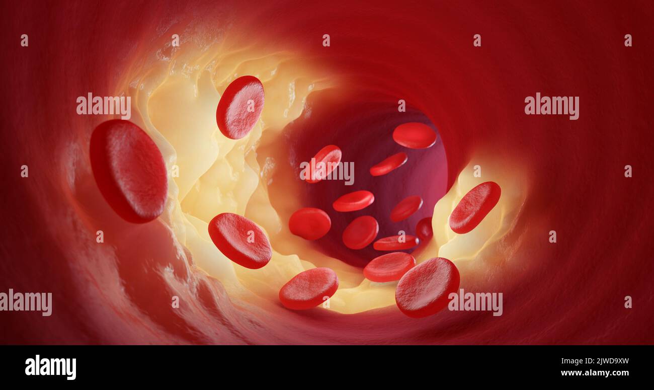 Rote Blutkörperchen treten durch die Cholesterinplaque in die Arterien oder Venen aus. 3D Abbildung. Stockfoto