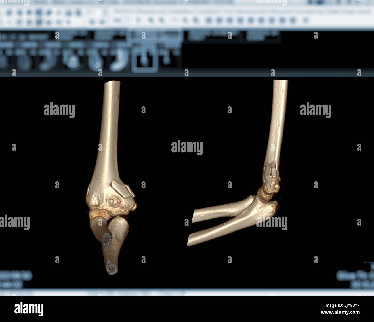 Computertomographie Volumendarstellung Untersuchung des Ellenbogengelenks 3D Rendering in Patientenfraktur Ellenbogengelenk. Stockfoto