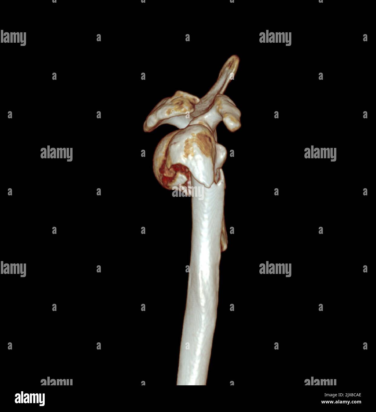 Computertomographie Volumendarstellung Untersuchung der Schulter 3D Rendering in Patientenfraktur Schultergelenk. Stockfoto