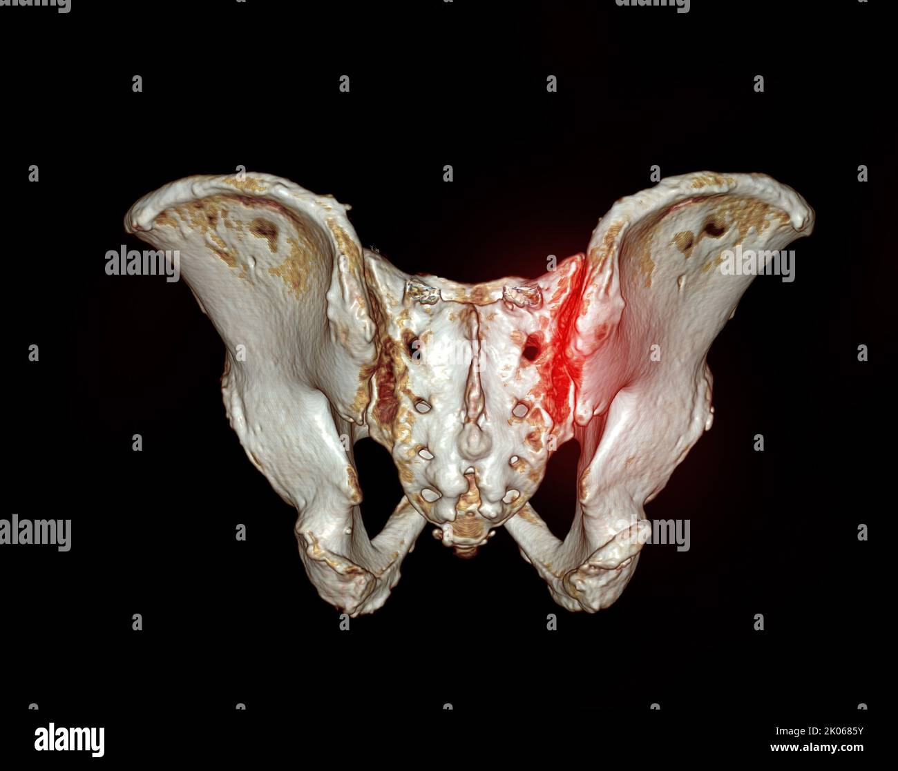 CT-Scan des Sacroiliac-Gelenks und Hüftgelenks 3D zur Diagnose Fraktur des Sacroiliac-Gelenks und Hüftgelenks Stockfoto