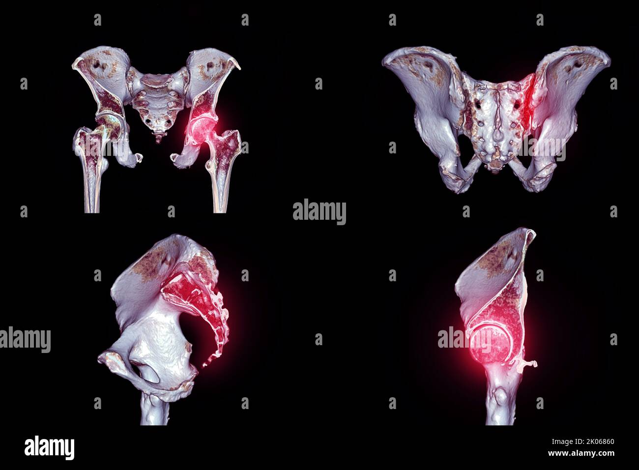 Sammlung eines traumatischen Fall-CT-Scans von Beckenknochen und Hüftgelenk 3D zur Diagnose Fraktur des Beckenknochens isoliert auf schwarzem Hintergrund. Stockfoto