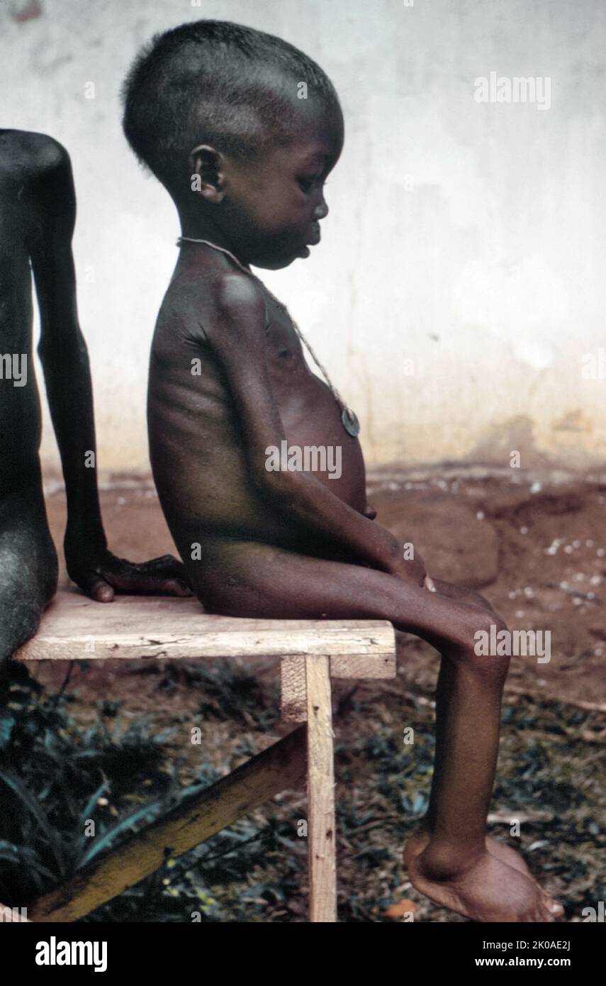 Das Foto Ende 1960s zeigt ein sitzendes, lustloses Kind, das unter vielen Kwashiorkor-Fällen war, die während des nigianisch-biafranischen Krieges in nigrischen Hilfslagern gefunden wurden. Kwashiorkor ist eine Krankheit, die aufgrund eines schweren Proteinmangels in der Ernährung verursacht wurde, und dieses Kind, dessen Ernährung einem solchen Mangelprofil entspricht, zeigte Symptome wie Ödeme an Beinen und Füßen, helle, dünner werdendes Haar, Anämie, einen Topfbauch, Und glänzende Haut Stockfoto