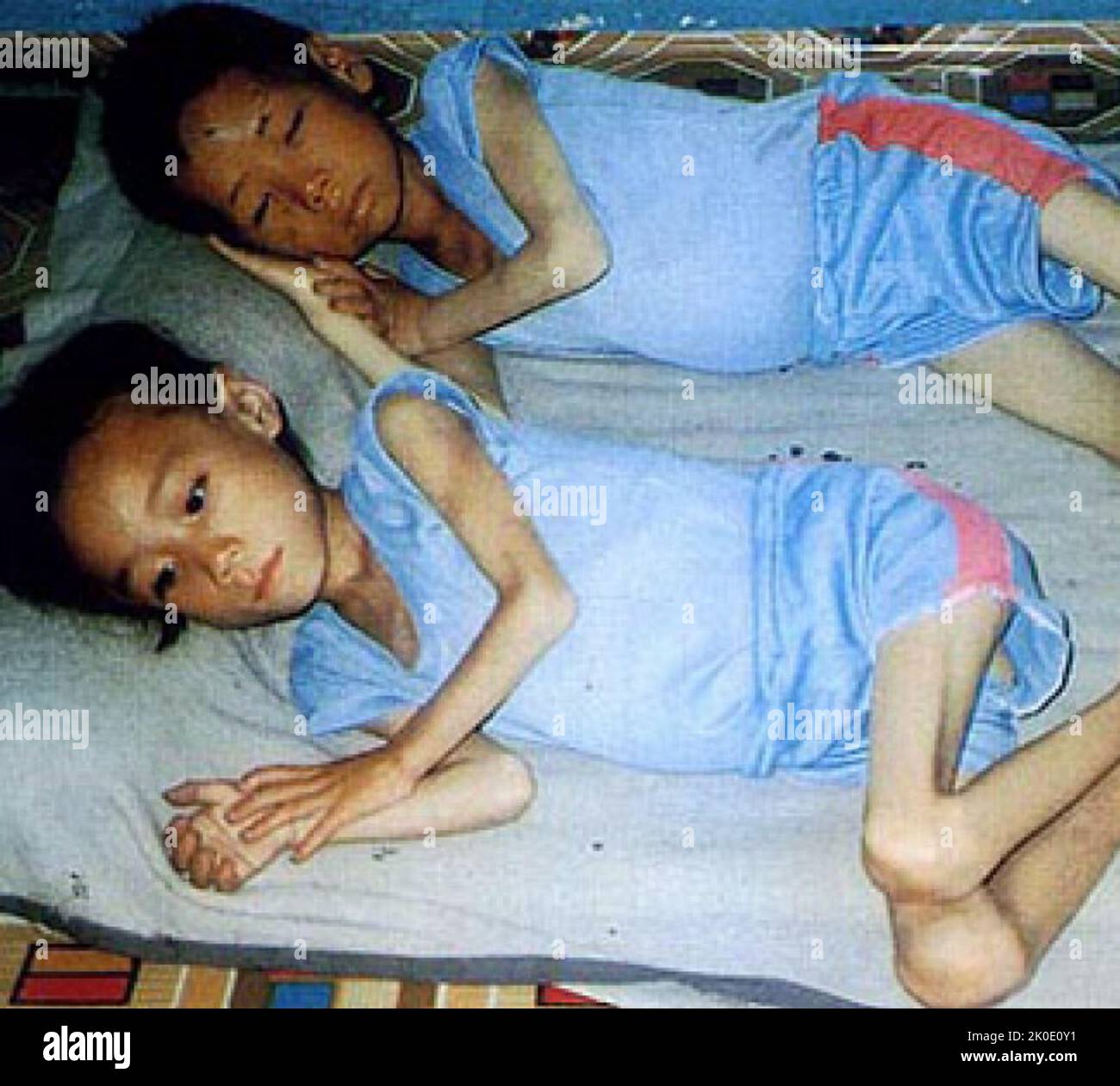 Abgemagerte Brüder und Schwestern liegen während der Hungersnot in Nordkorea in den 1990er Jahren 1997 im Unsun-Kindergarten in Süd-Pjöngjang anfällig Stockfoto