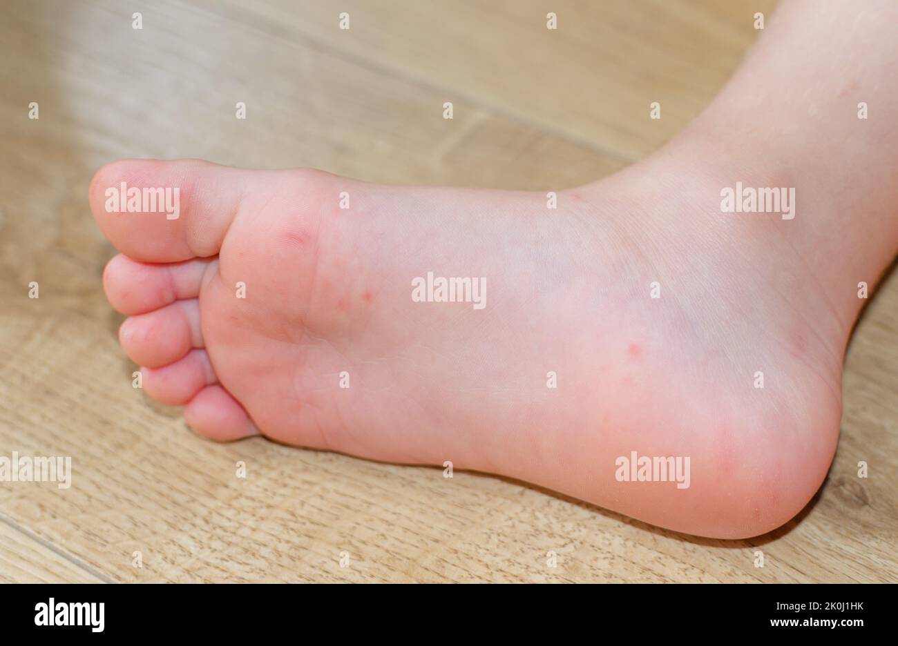 EnterovirusFüße Hautausschlag auf den Körper eines Kindes. Cocksackie