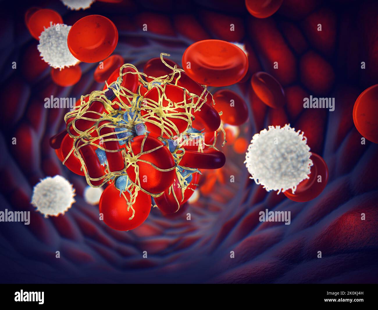 Aktivierte Blutplättchen (Thrombozyten) bilden ein Blutgerinnsel (Thrombus), das mit Fibrin-Mesh bedeckt ist. Die Blutplättchen sind Blutzellen, die den Blutgefäßschaden reparieren Stockfoto
