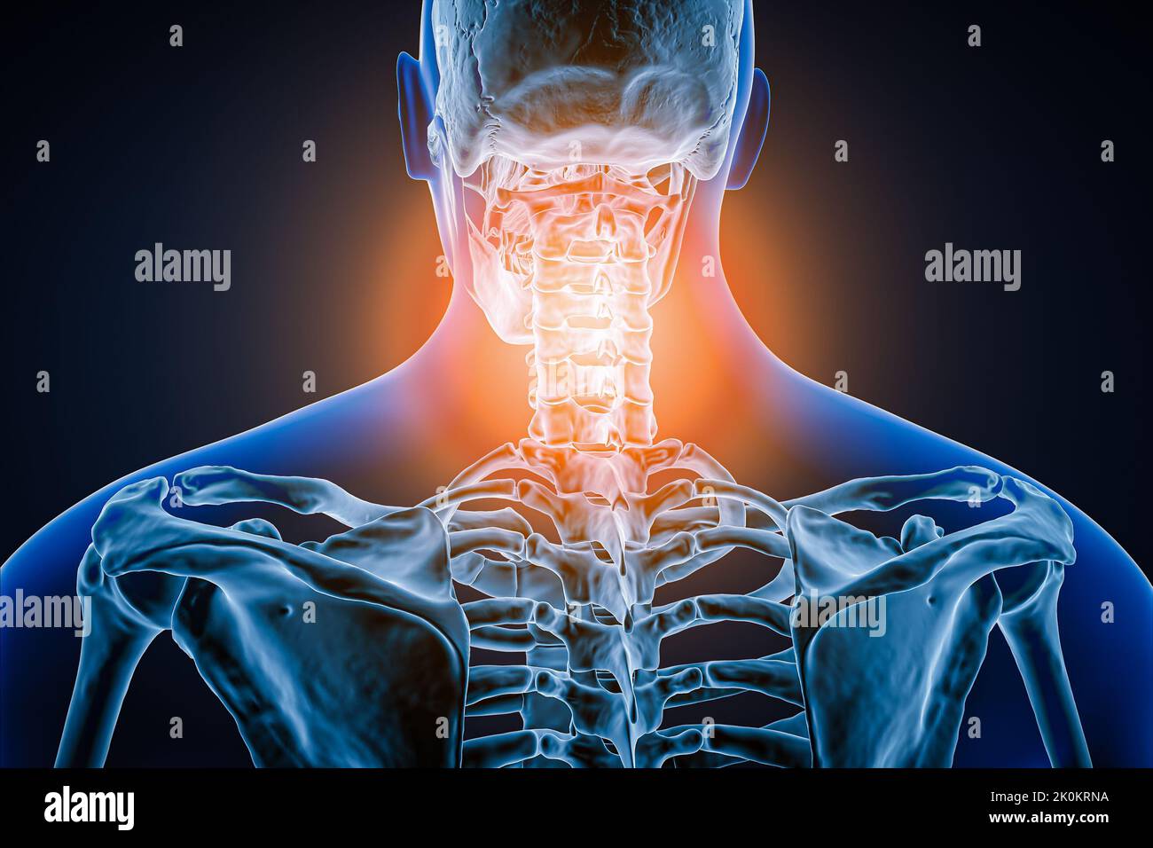 Hintere oder hintere Ansicht der menschlichen Wirbelsäule oder Wirbelsäule mit Entzündung oder Verletzung 3D Darstellung der Abbildung. Pathologie, Rückenschmerzen, Anatomie, cervi Stockfoto