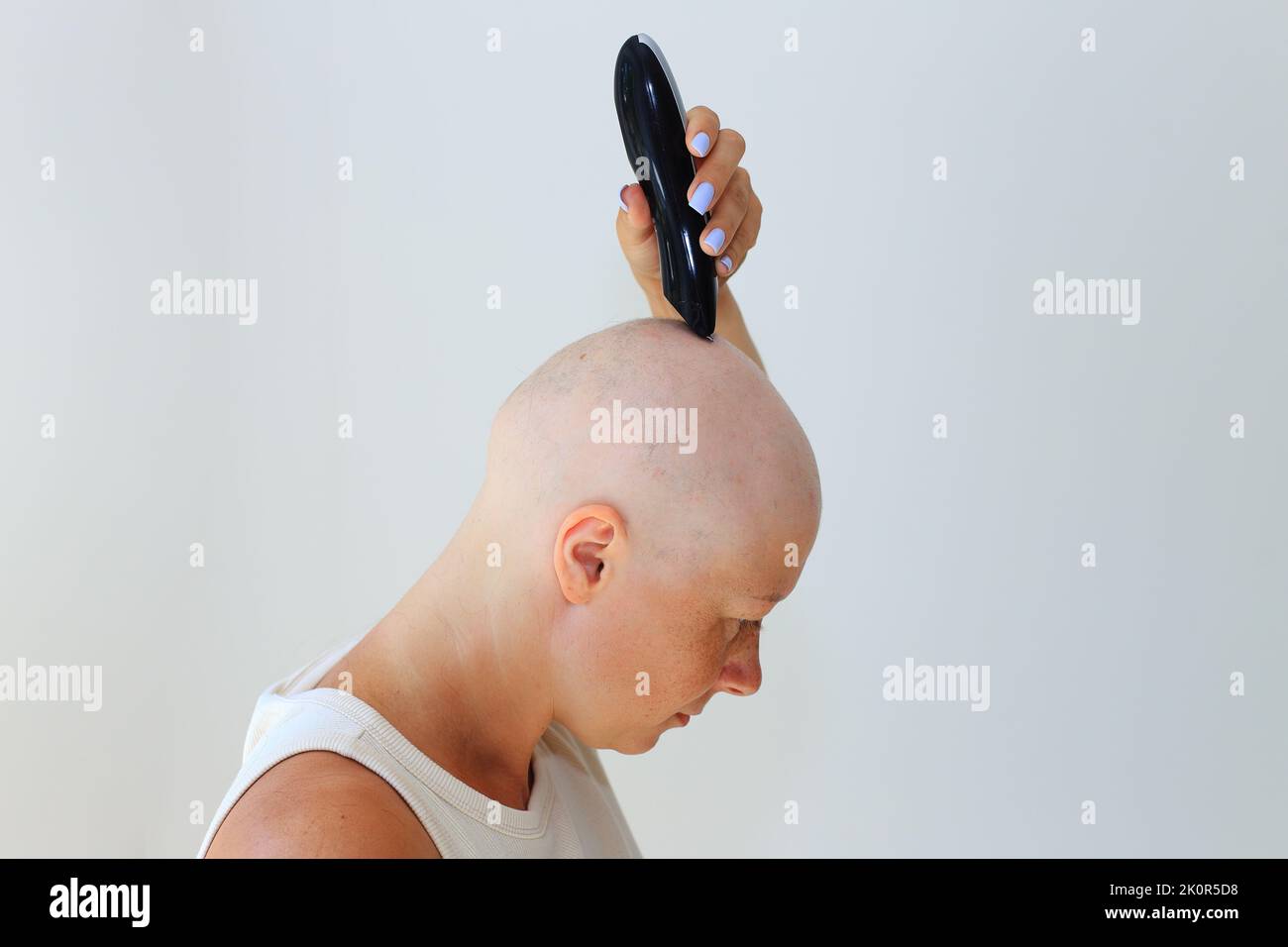 Folgen einer Chemotherapie. Rasieren Sie die letzten Haare auf dem Kopf mit einem Rasierer. Kopf